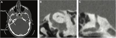 Vestibular Evoked Myogenic Potential (VEMP) Testing for Diagnosis of Superior Semicircular Canal Dehiscence